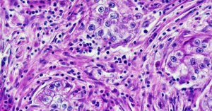 AI Cancer Diagnostics Show Racial Disparities, Harvard-Led Review Finds